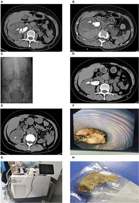 Providing Several Skills to Treat Complex Infectious Stones of Solitary Kidney in a Patient Failed to Undergo Percutaneous Nephrolithotomy: A Case Report